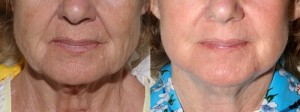 facelift surgery scotland