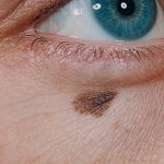 Skin cancer surgery edinburgh