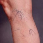 thread vein treatment edinburgh