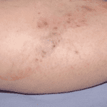 effects of injecting threadveins