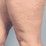 treatment of thigh threadveins scotland