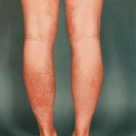 Arborising telangectasia on legs