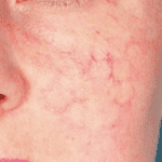 treatment of facial threadveins scotland