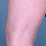 Resolution of bruising with only slight improvement in thread veins (see microsclerotherapy