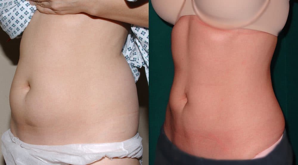 https://www.quaba.co.uk/wp-content/uploads/2013/12/liposuction-before-and-after-3.jpg