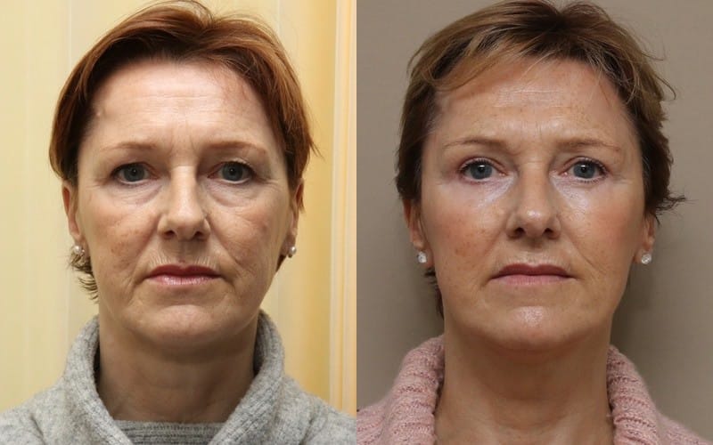 Facelift Surgery Scotland Quaba Plastic Surgery Edinburgh