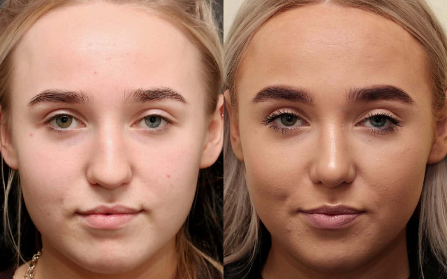 Before And After Rhinoplasty Photos Quaba Cosmetic Surgery Uk 0581