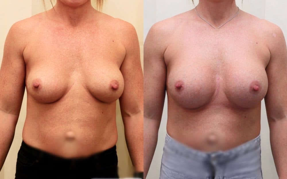 Exchange Of Breast Implants From 330cc To 460cc Full Profile Round Implants