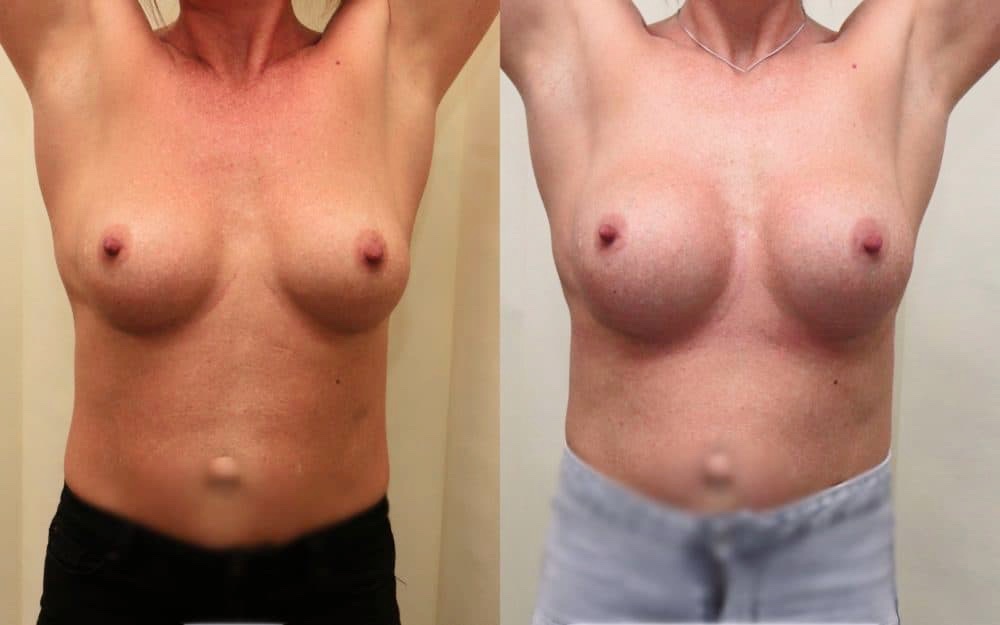 Exchange Of Breast Implants From 330cc To 460cc Full Profile Round Implants