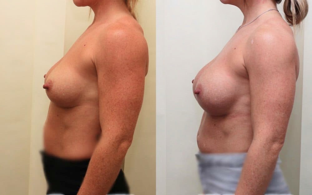 Exchange Of Breast Implants From 330cc To 460cc Full Profile Round Implants