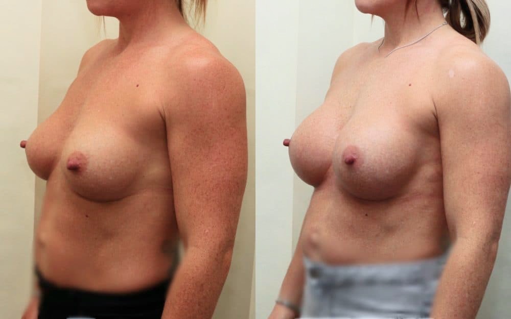 Exchange Of Breast Implants From 330cc To 460cc Full Profile Round Implants