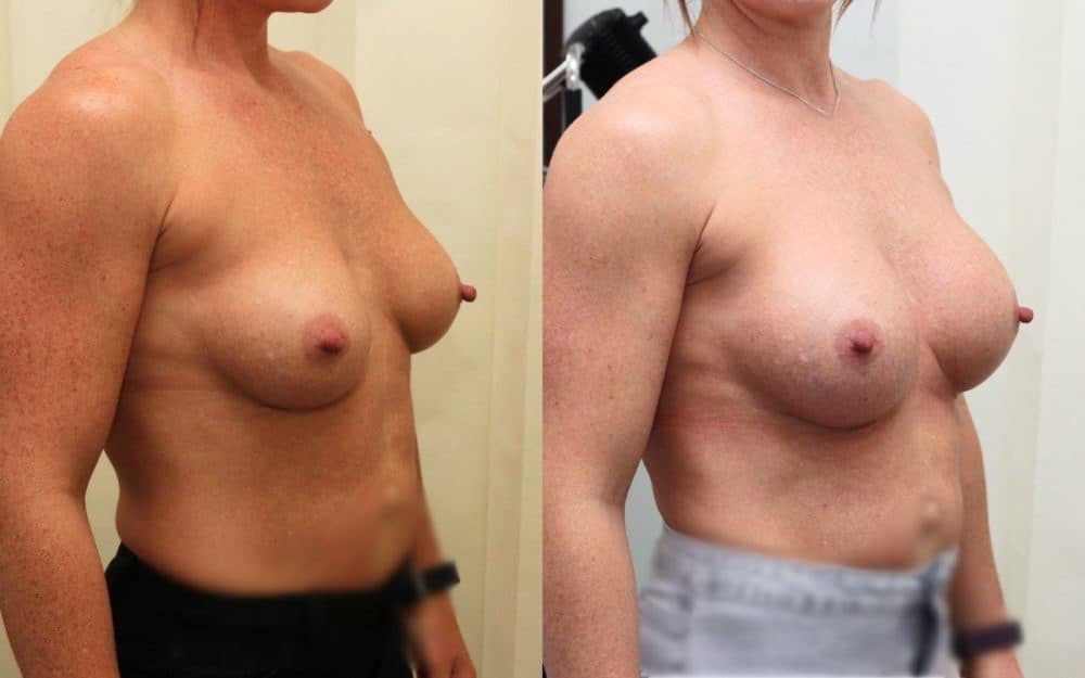 Exchange Of Breast Implants From 330cc To 460cc Full Profile Round Implants