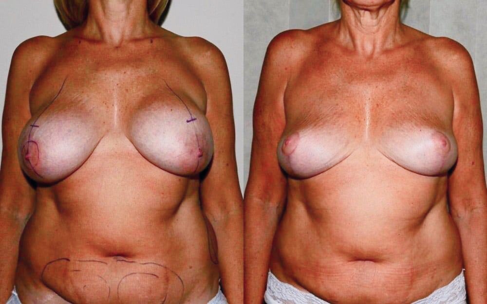 Removal of breast implants, breast uplift and fat transfer to the breasts