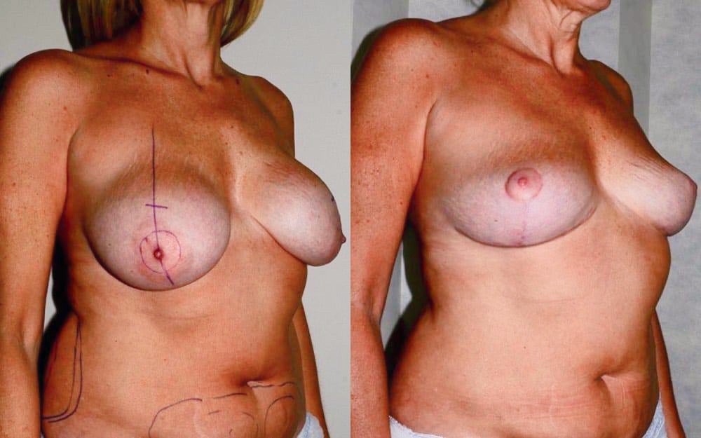 Removal of breast implants, breast uplift and fat transfer to the breasts