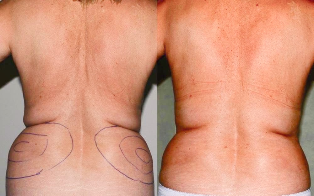 Removal of breast implants, breast uplift and fat transfer to the breasts