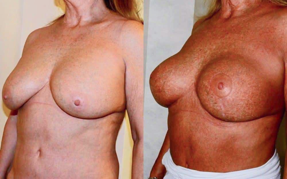 Replacement of ruptured breast implants