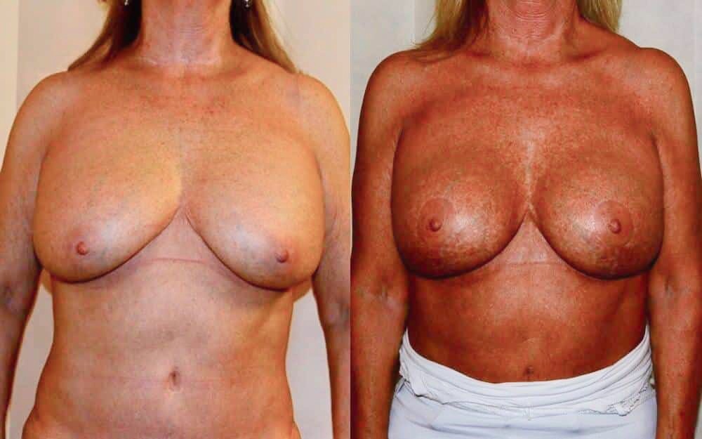 Replacement of ruptured breast implants