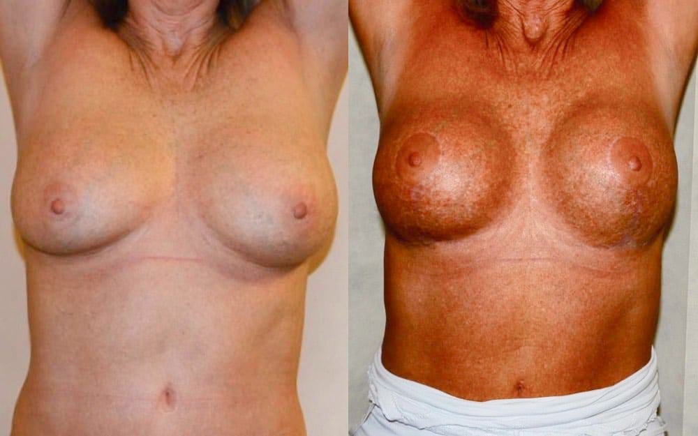 Replacement of ruptured breast implants