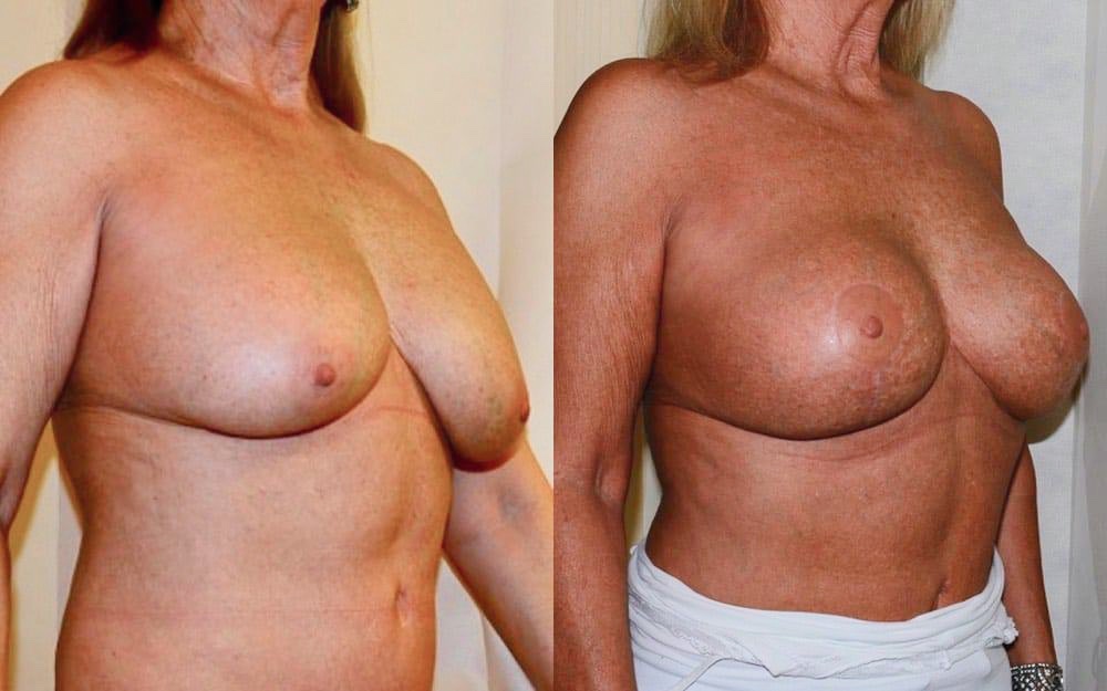 Replacement of ruptured breast implants