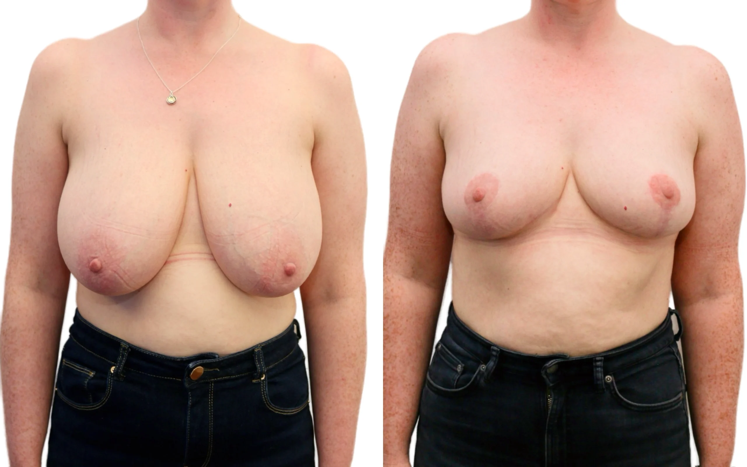 before and after breast reduction quaba