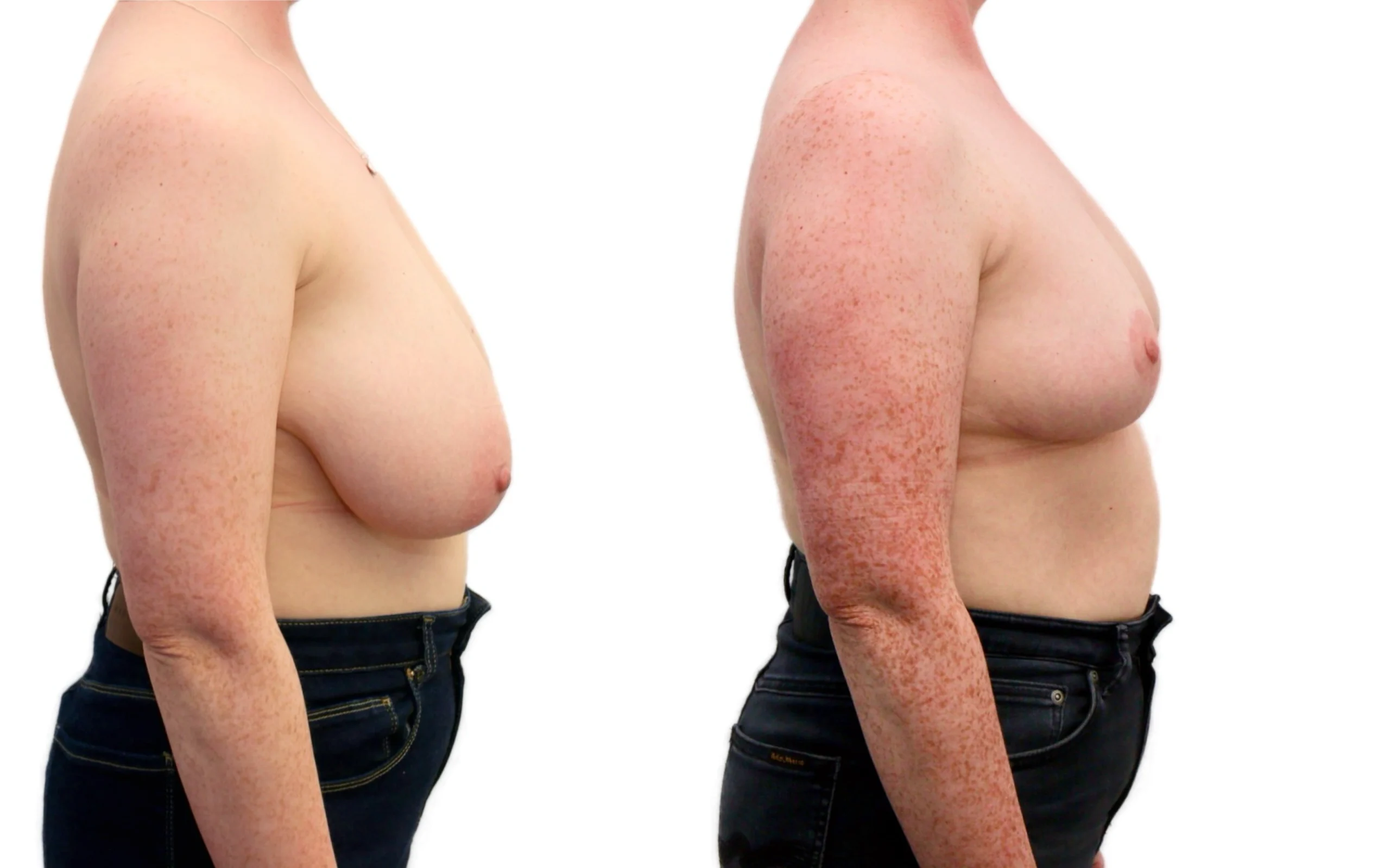 Moderate breast reduction before and after