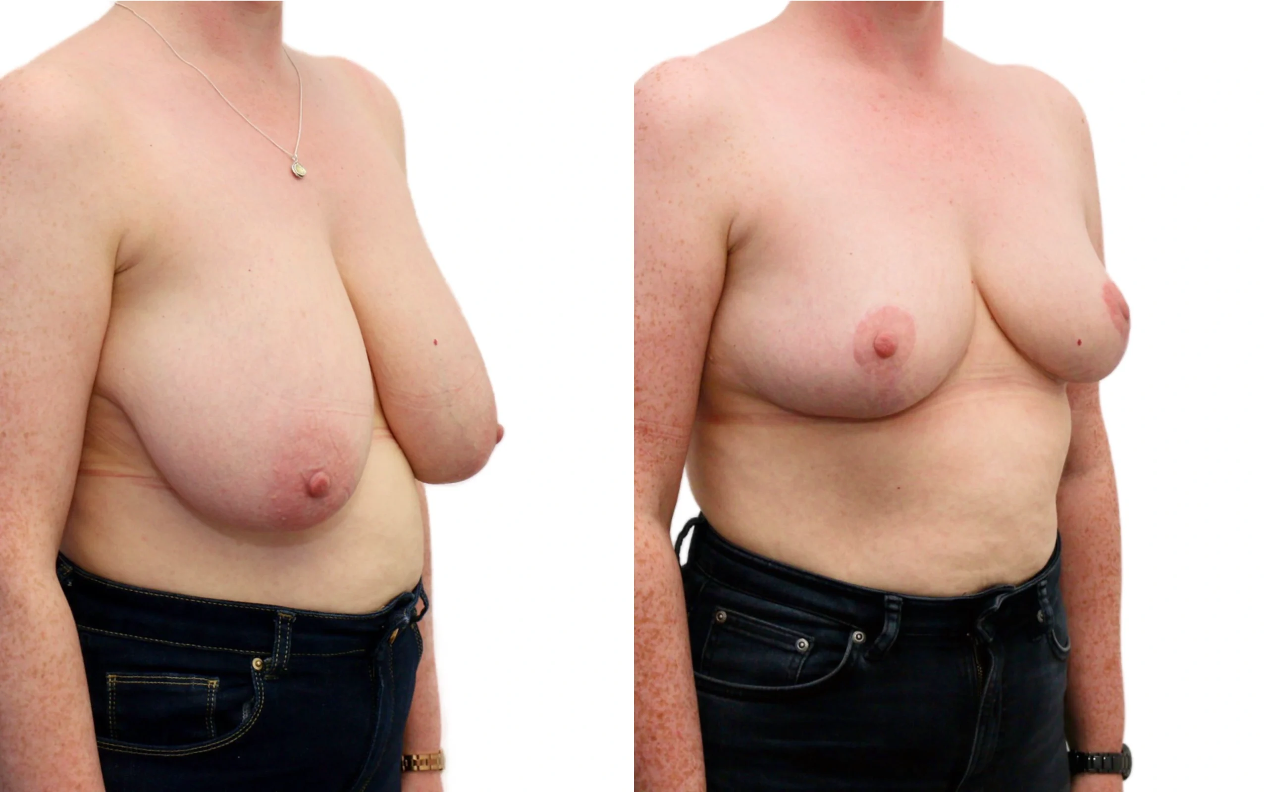 Moderate breast reduction before and after