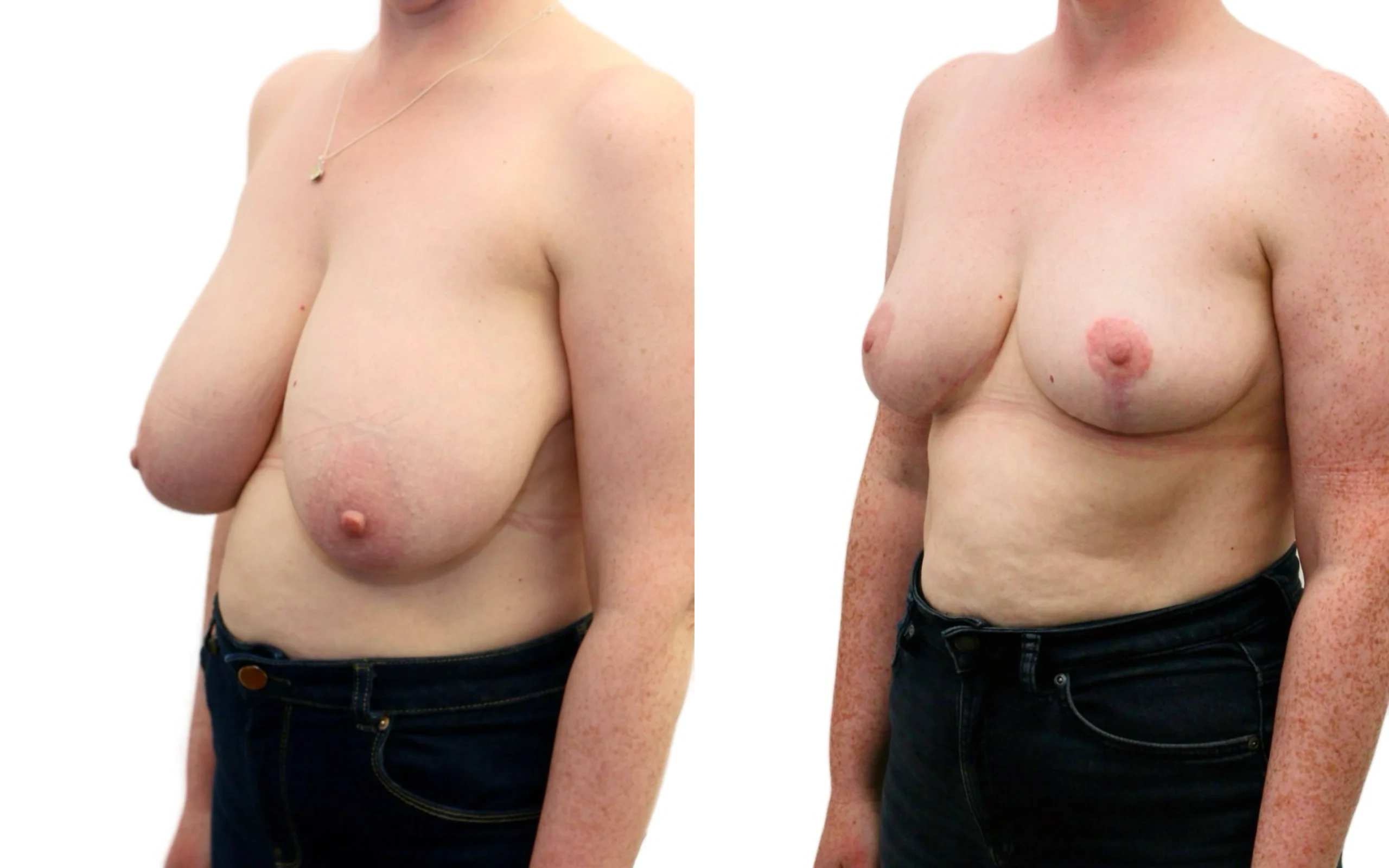 Moderate breast reduction before and after