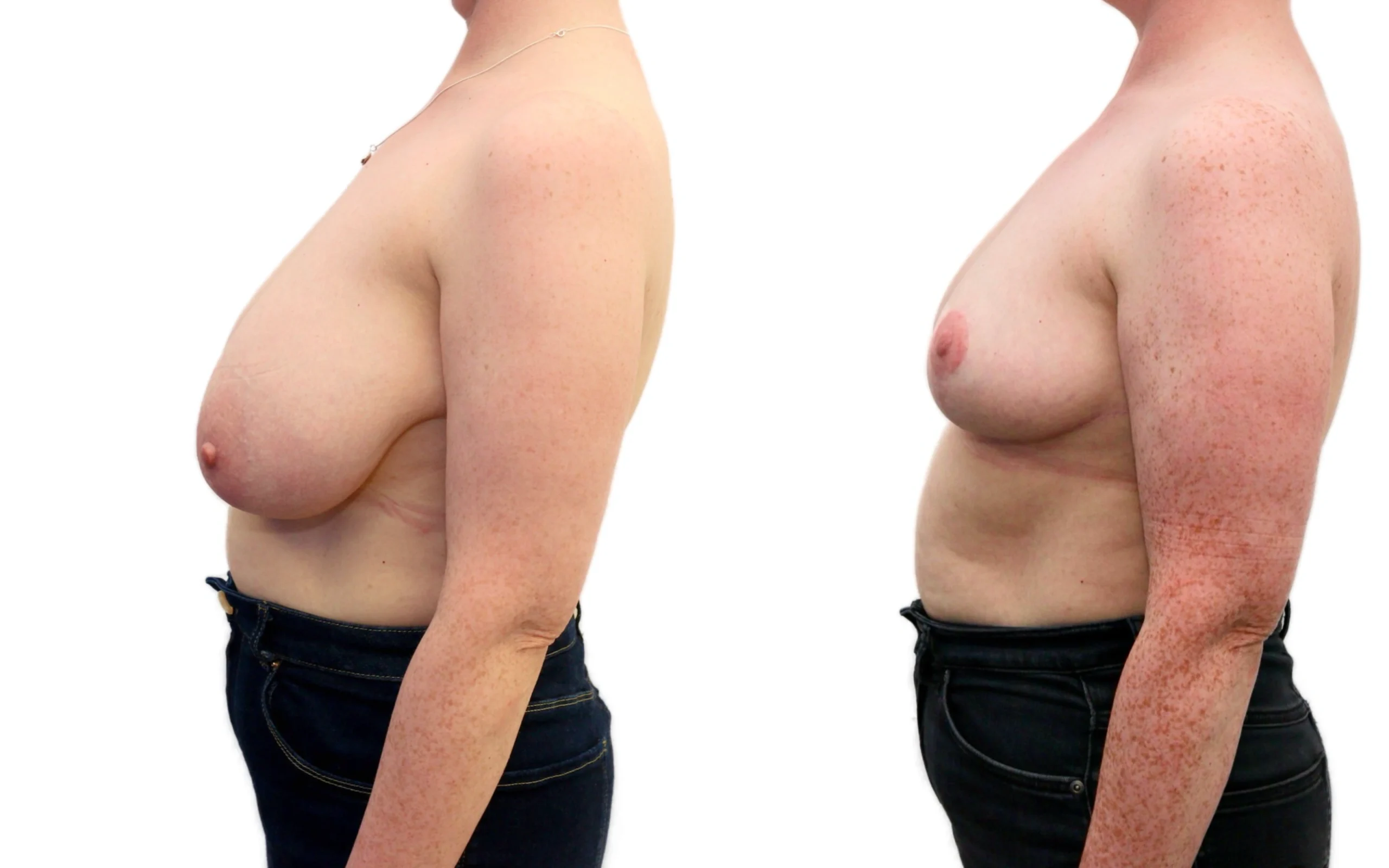 Moderate breast reduction before and after