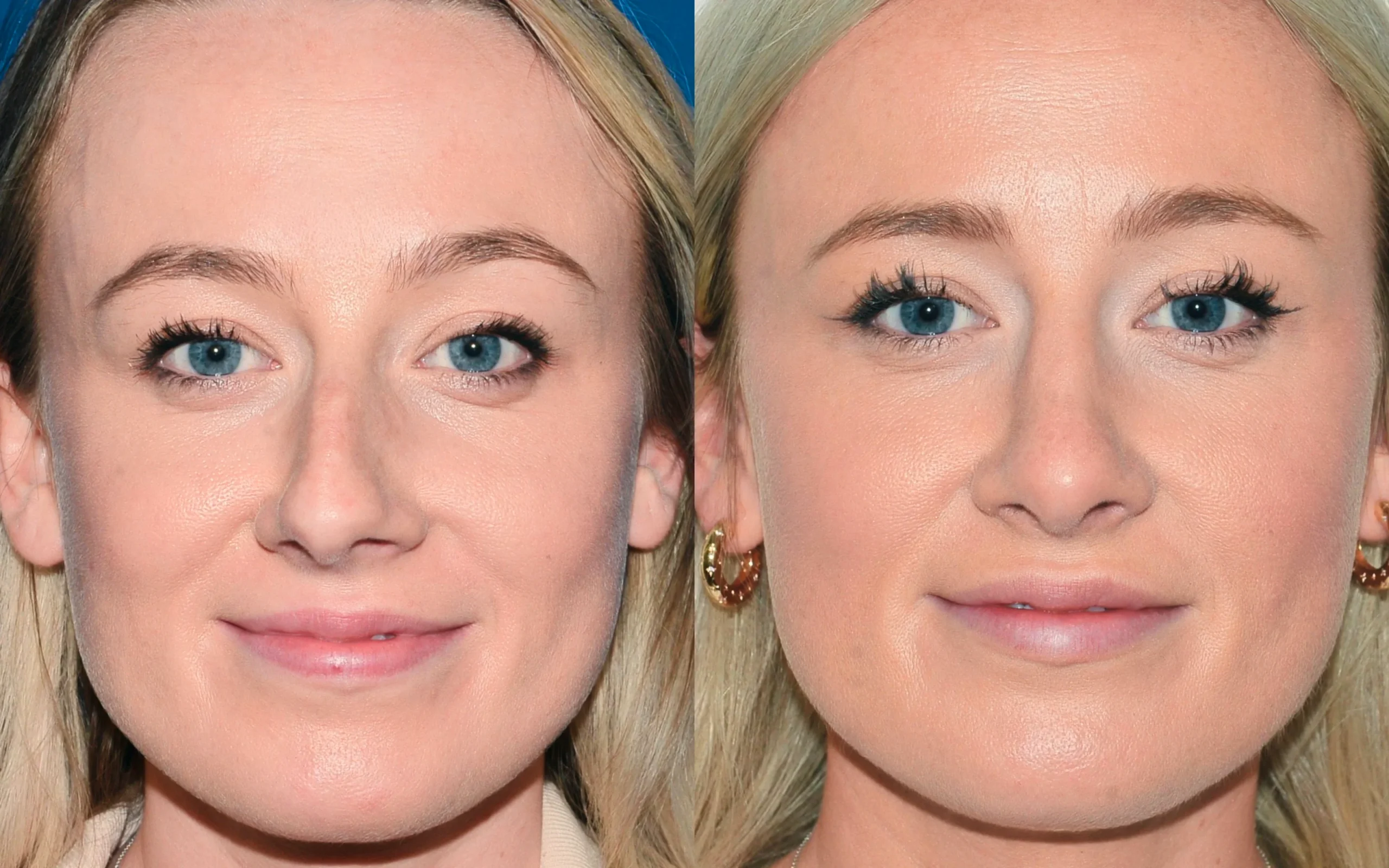 septorhinoplasty before and after