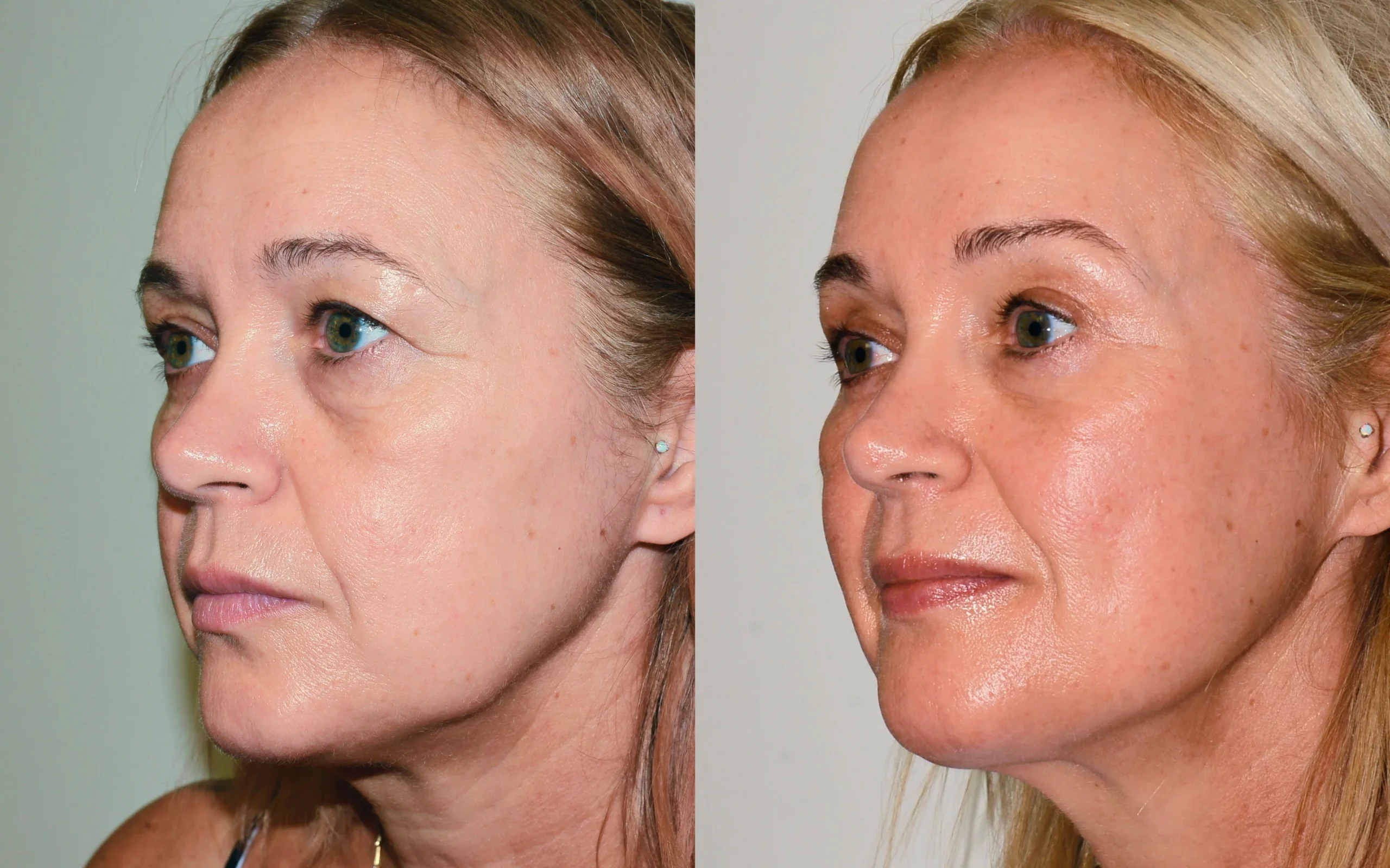 Direct brow lift and eyelid surgery