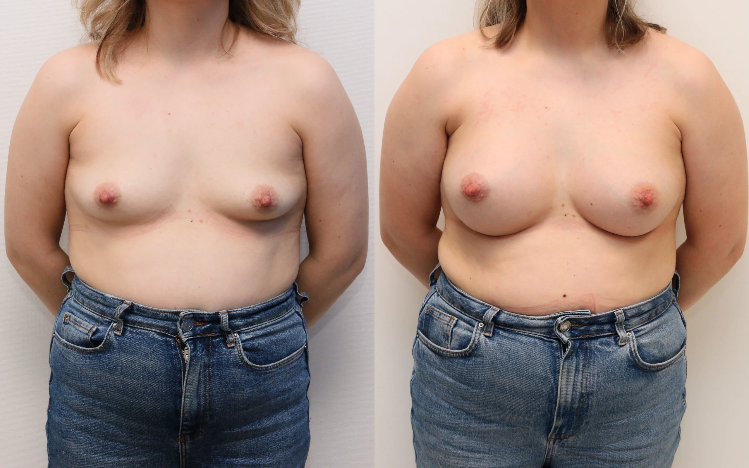 above the muscle breast implants before and after