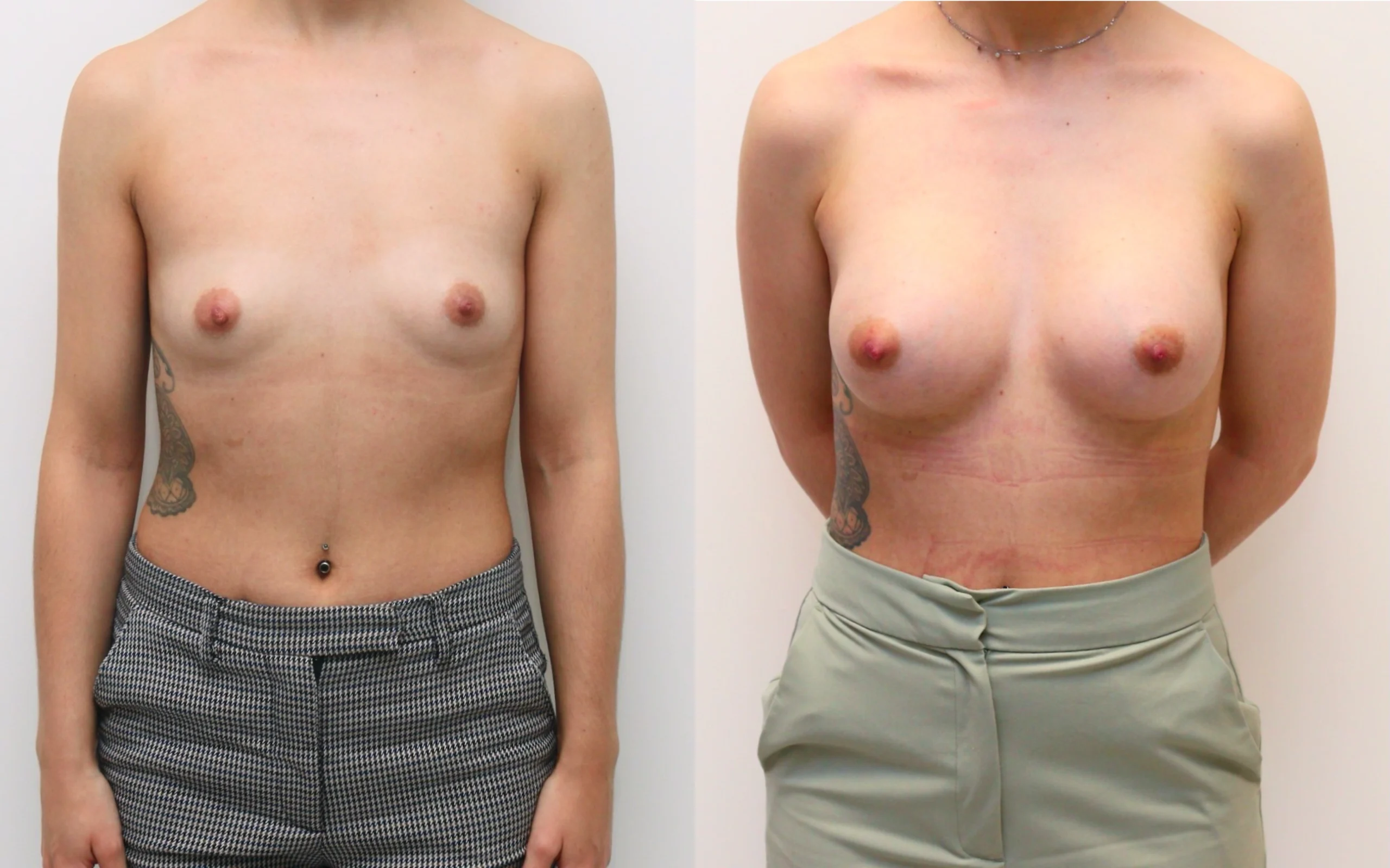 275cc implants before and after