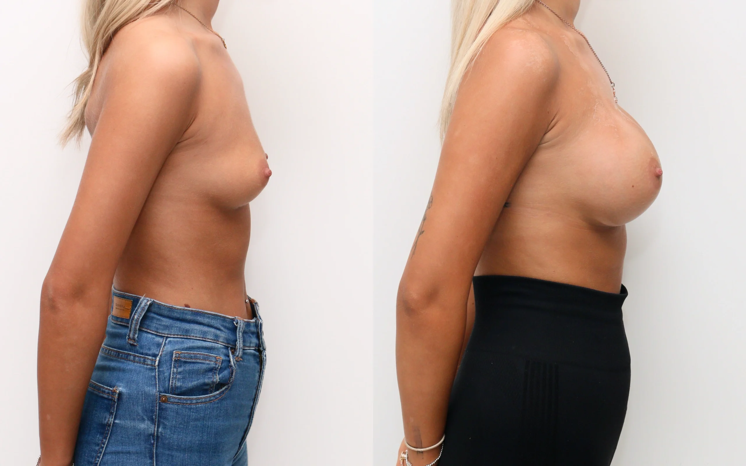 350cc high profile dual plane breast augmentation