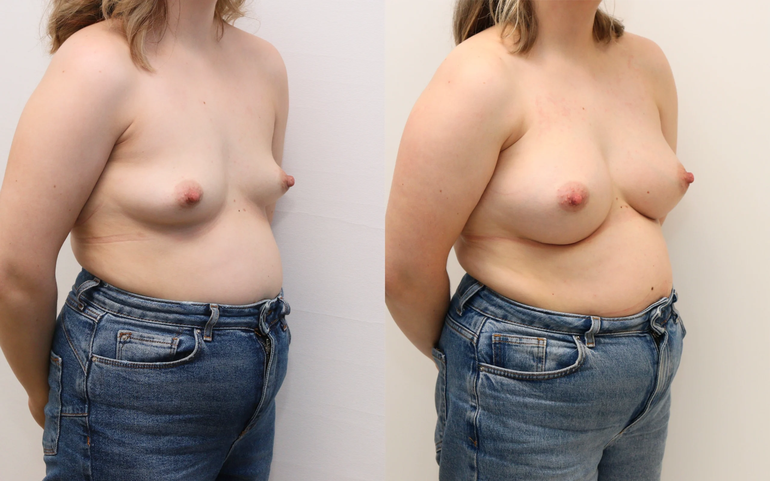 above the muscle breast implants before and after