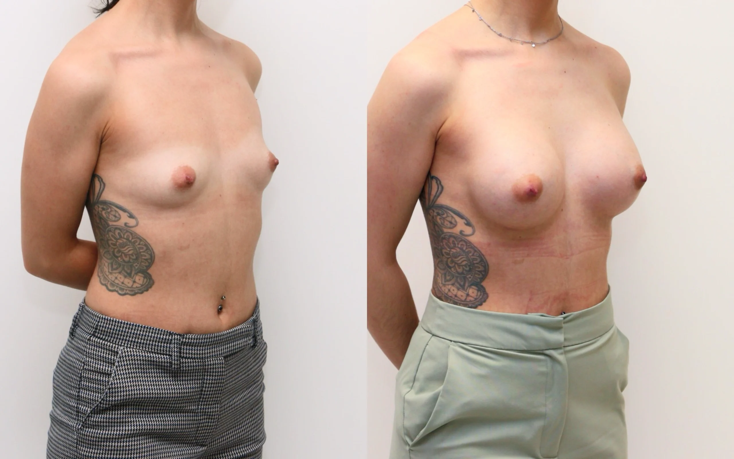 275cc implants before and after