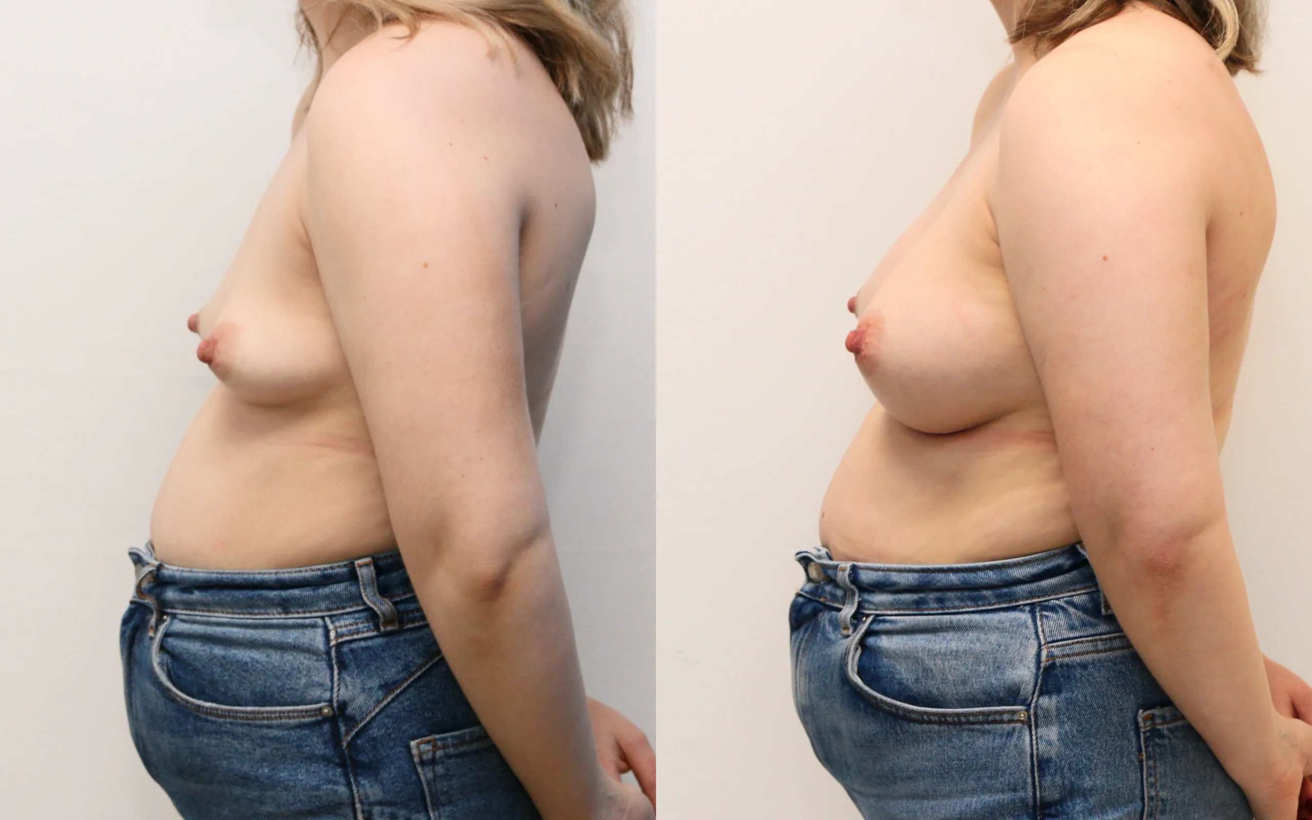 above the muscle breast implants before and after