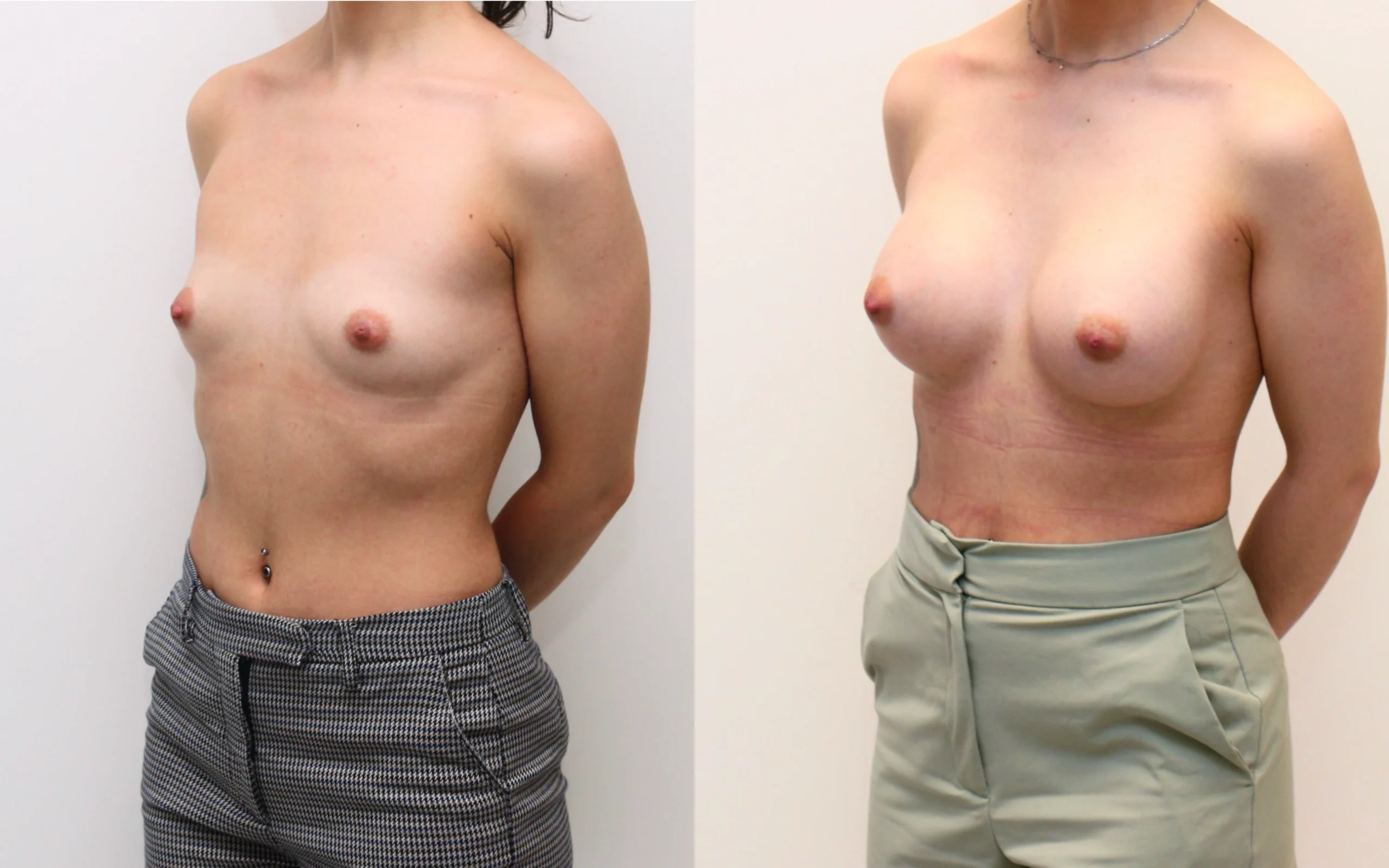 275cc implants before and after