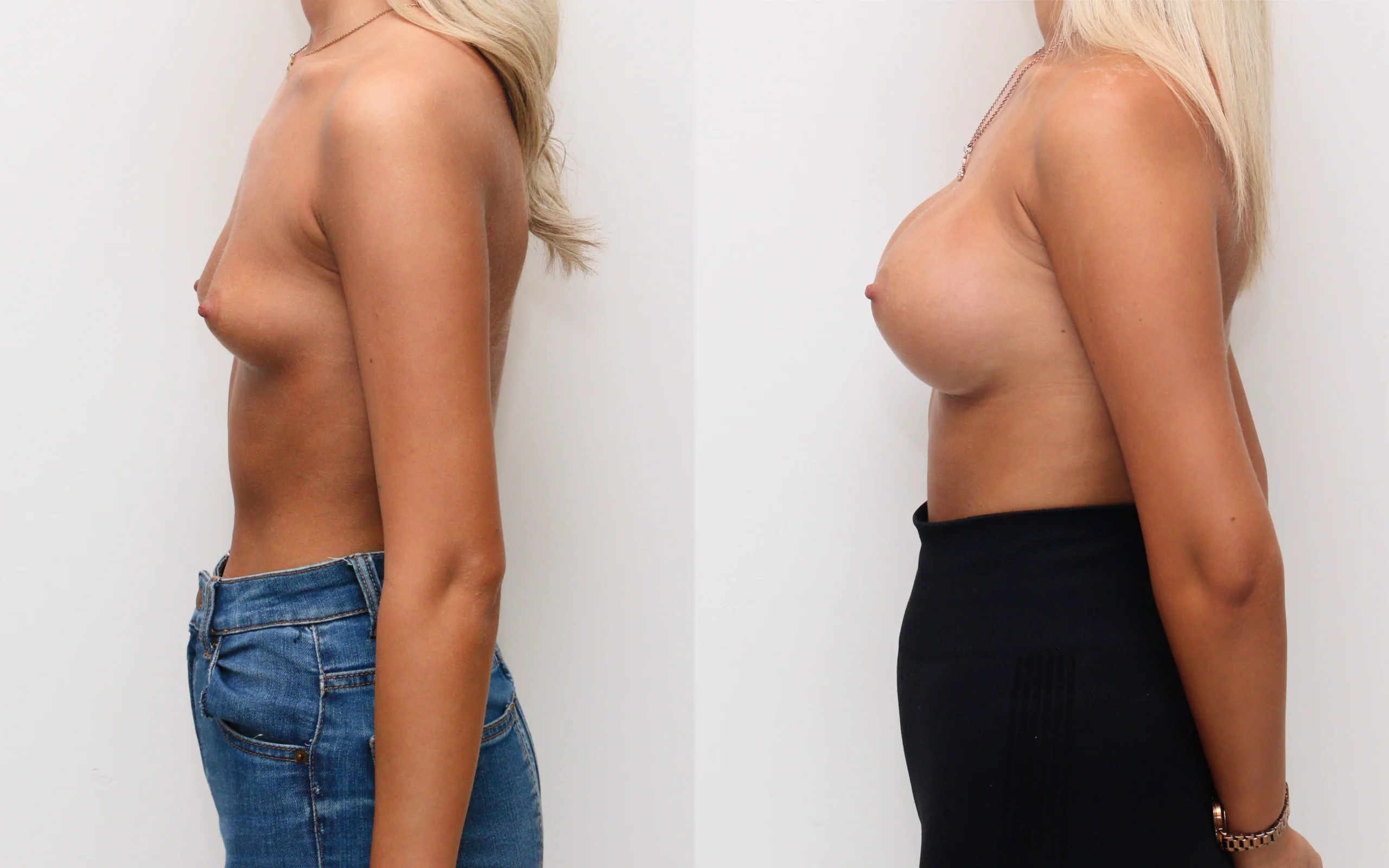 350cc high profile dual plane breast augmentation