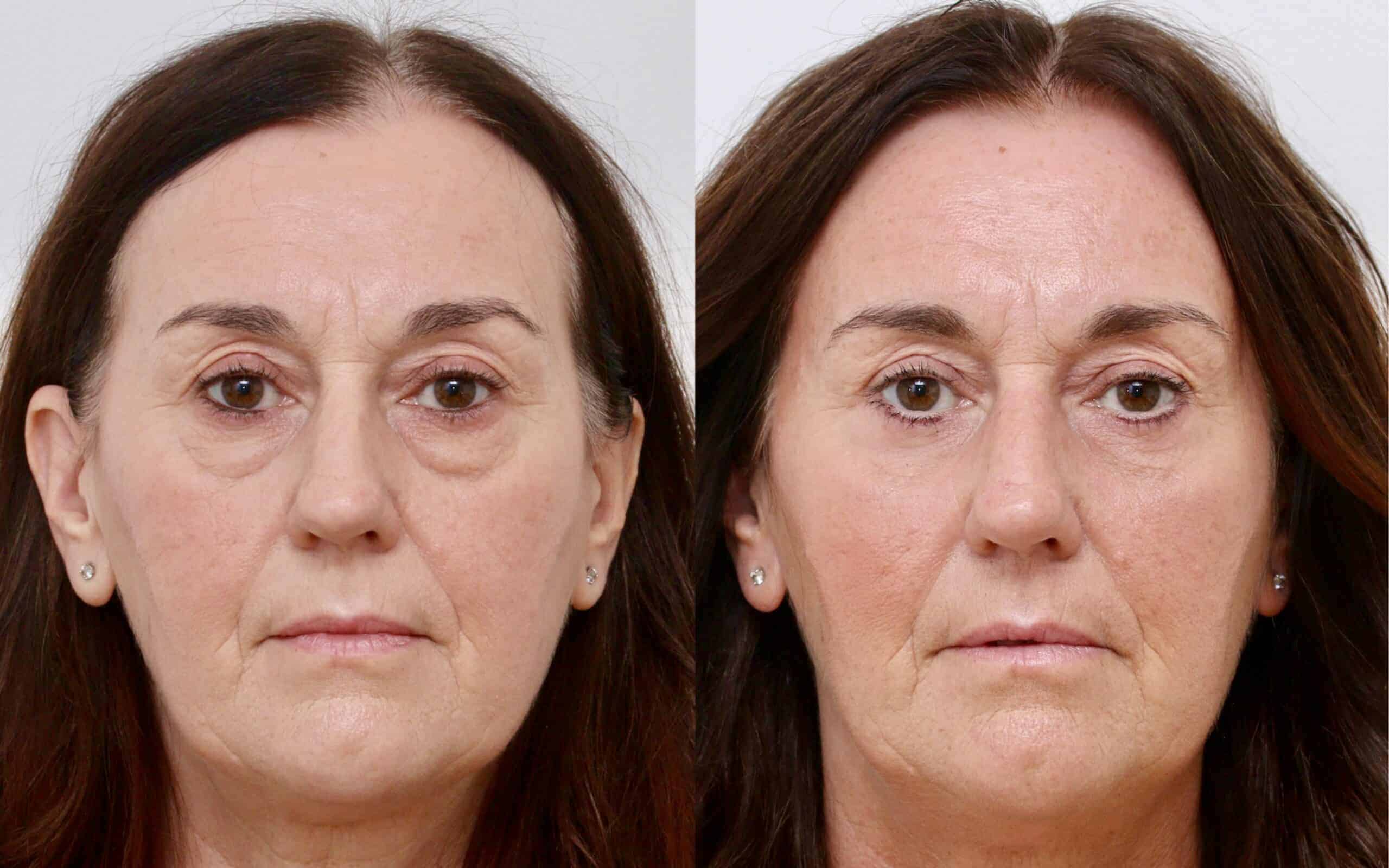 Eye Lift Surgery Aberdeen, Eye Lid Surgery Dundee