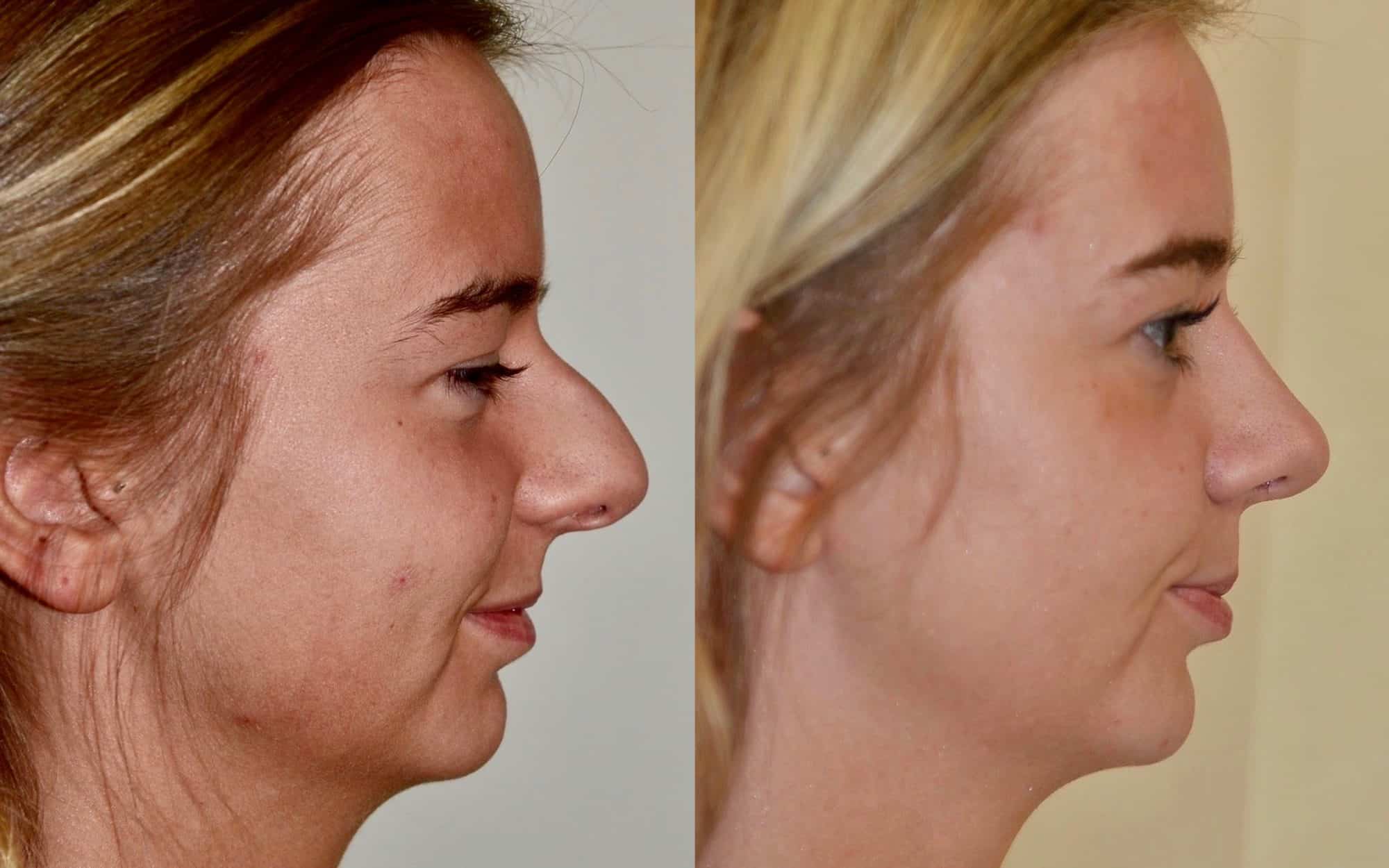 rhinoplasty glasgow