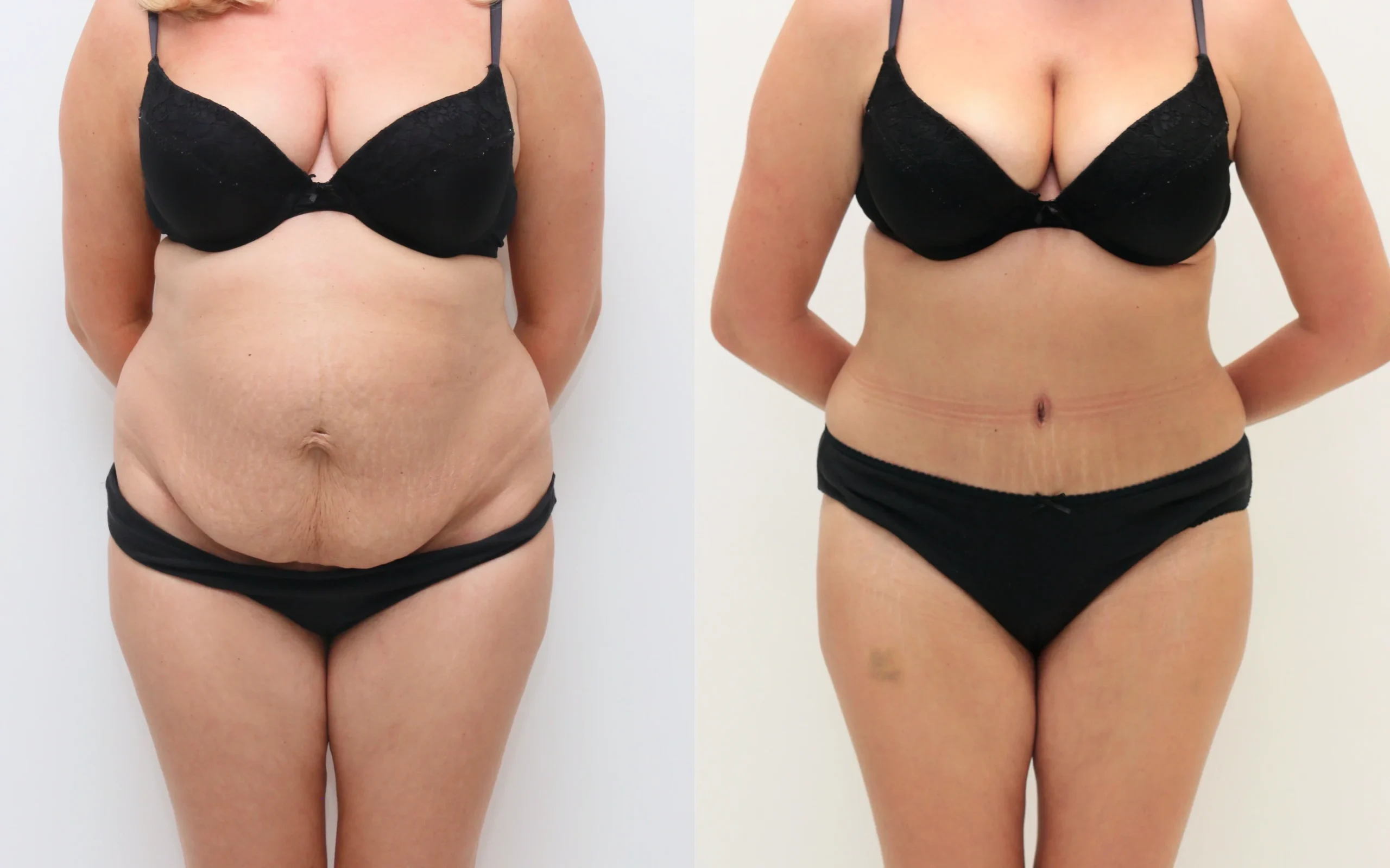 Tummy tuck with muscle repair