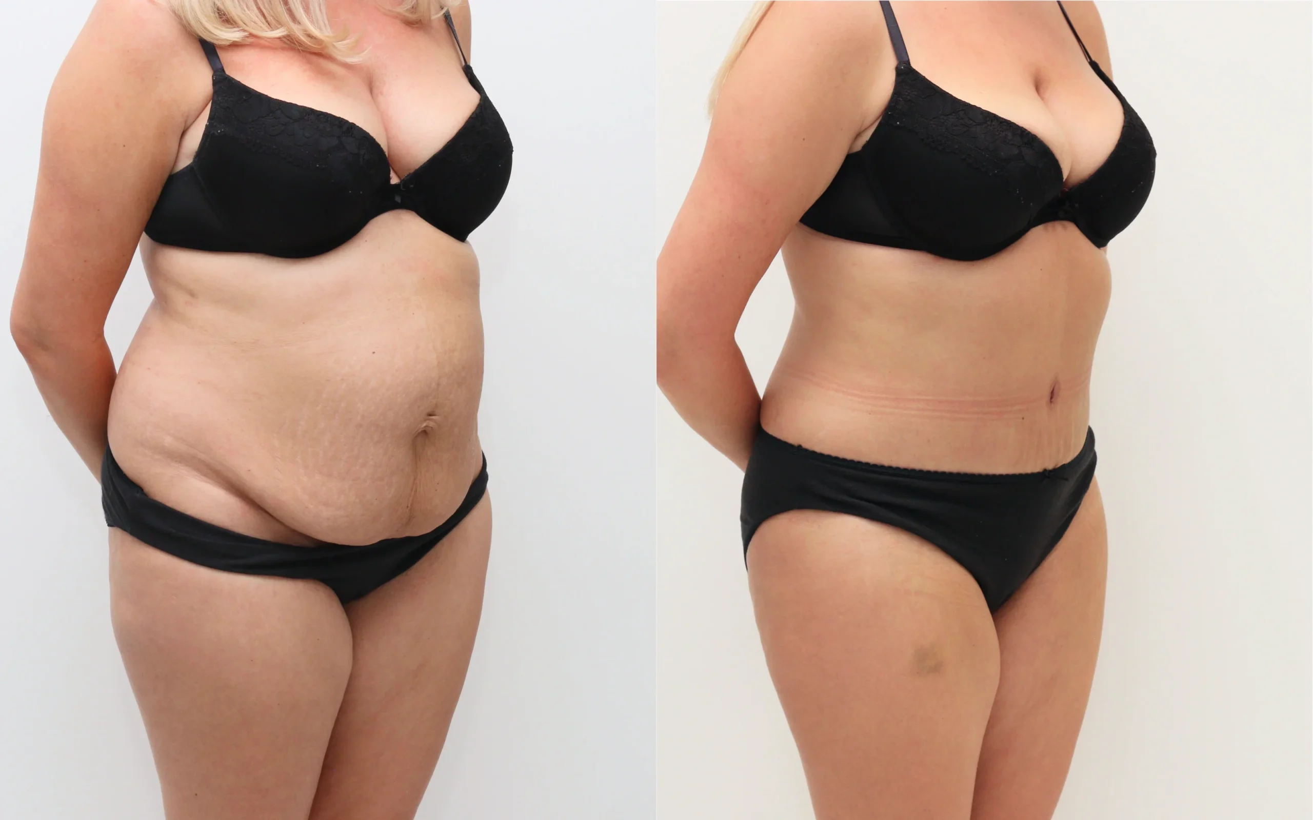 Tummy tuck with muscle repair