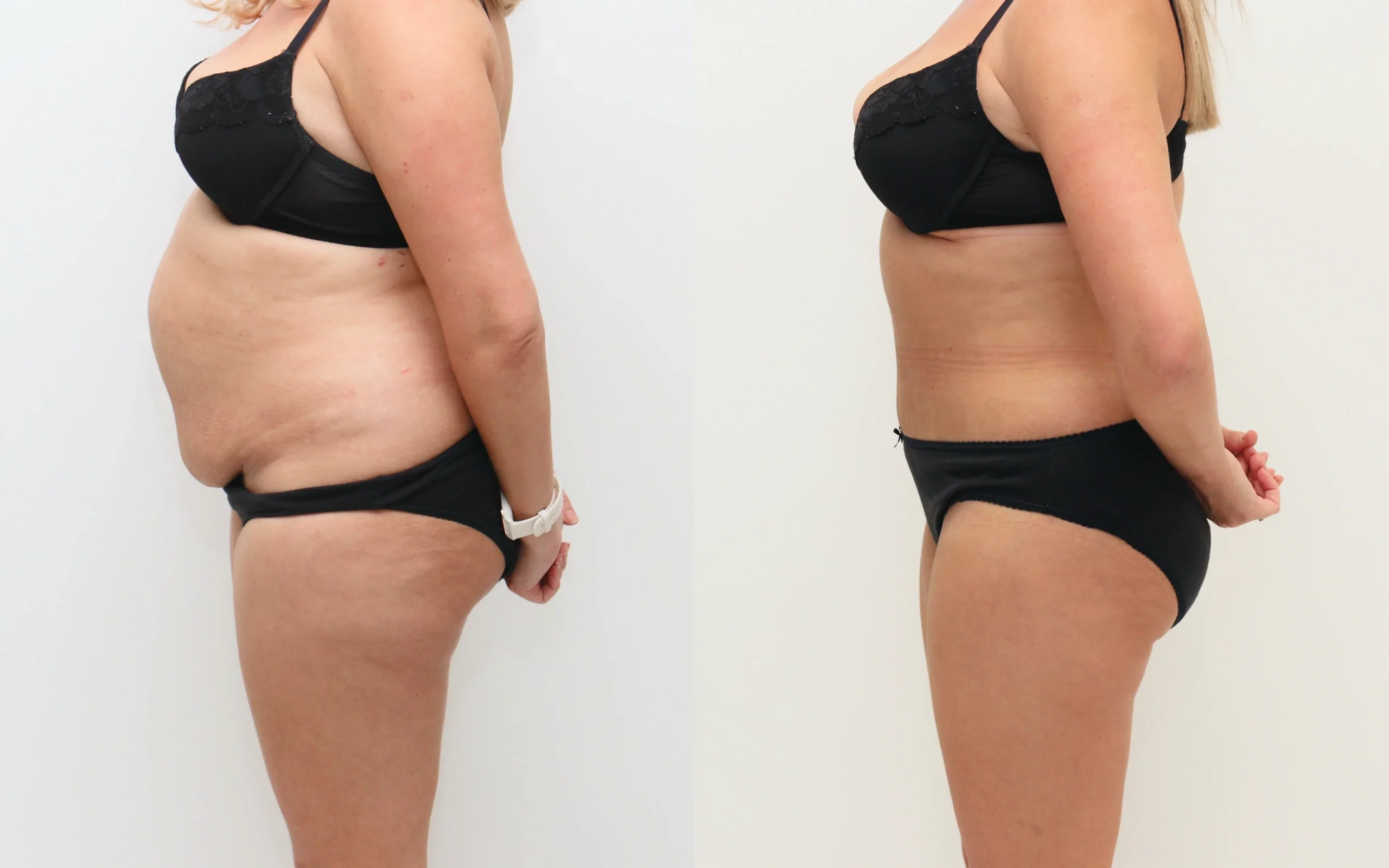 tummy tuck before and after scotland