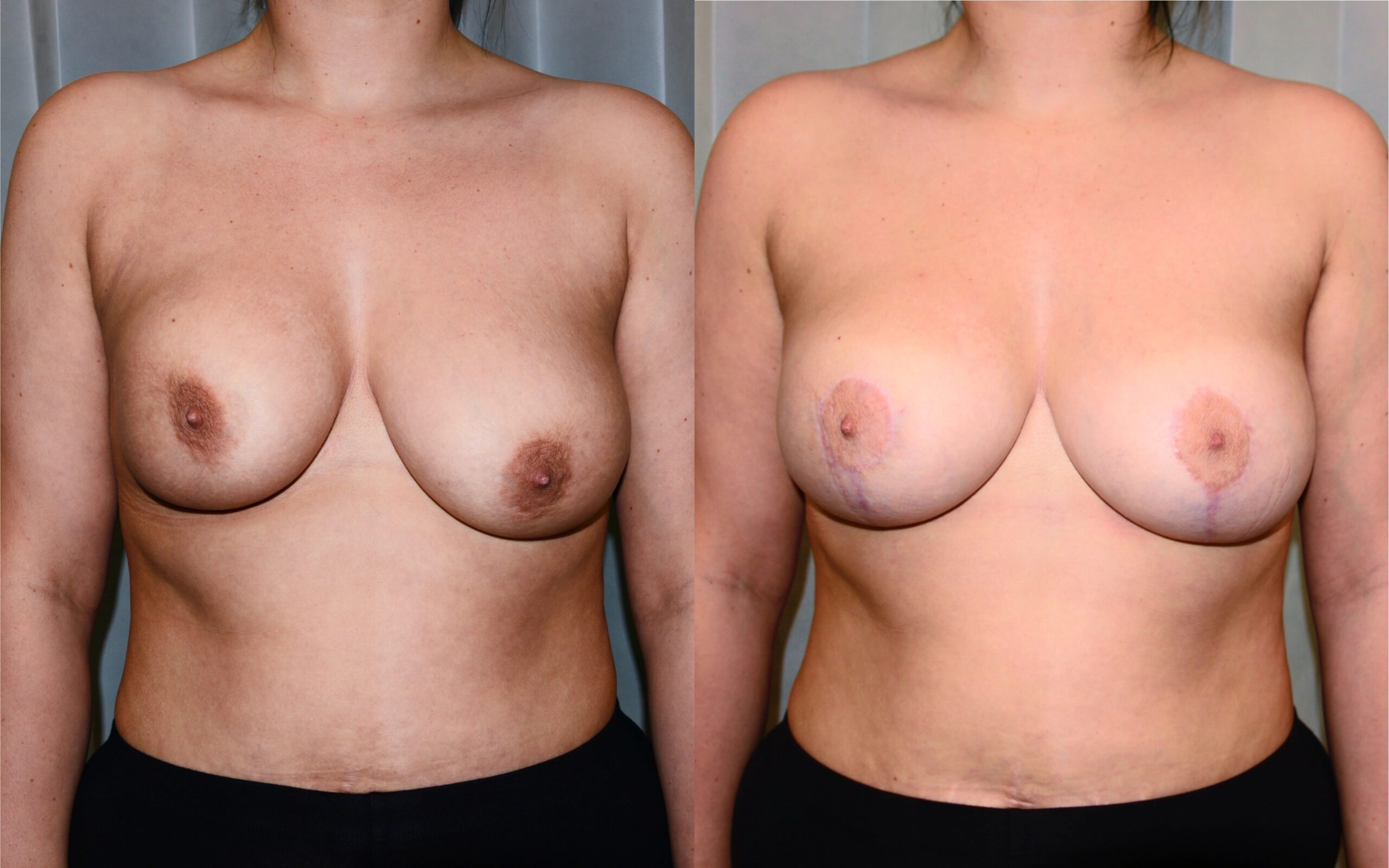 Correction of breast asymmetry