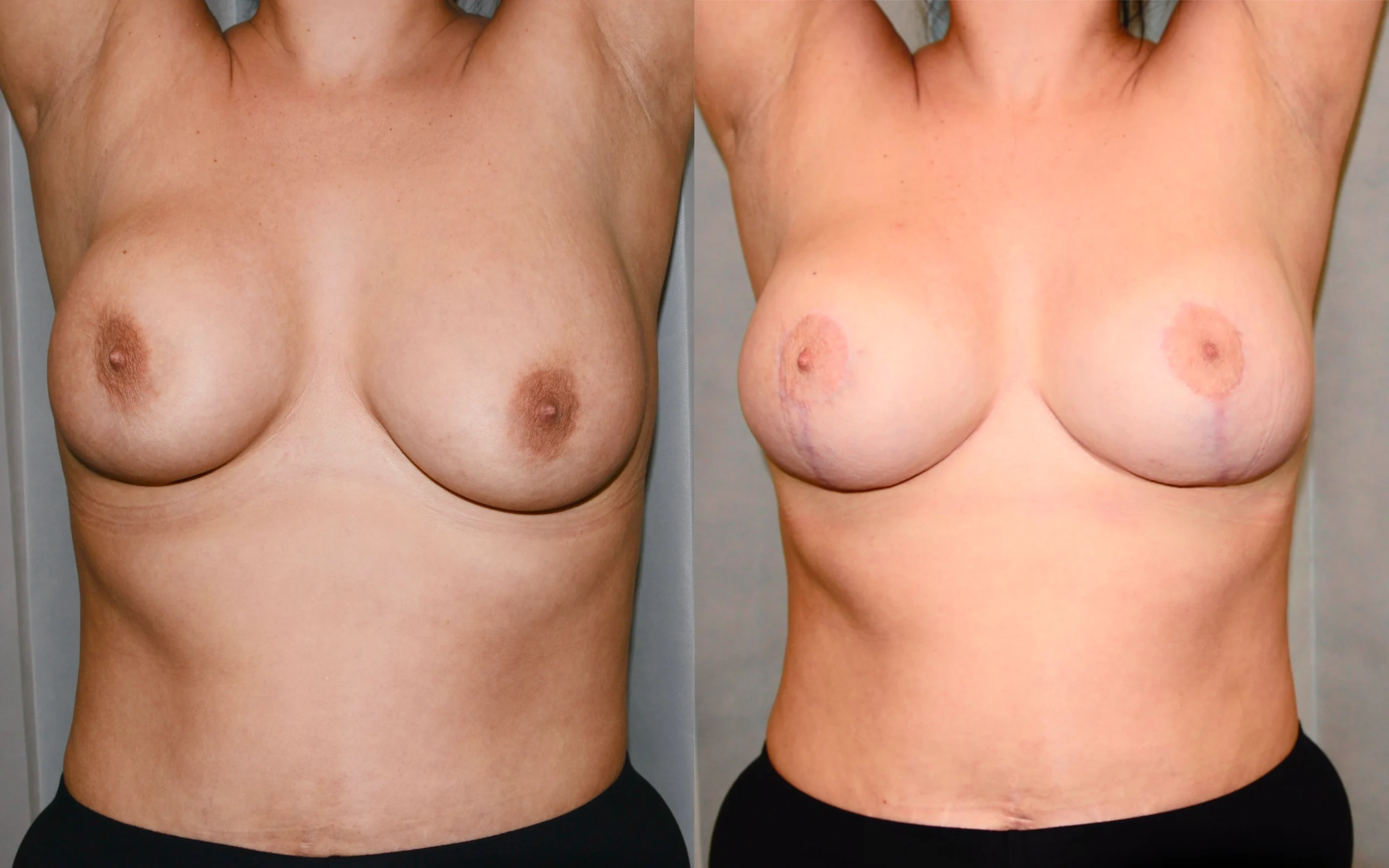 breast asymmetry correction