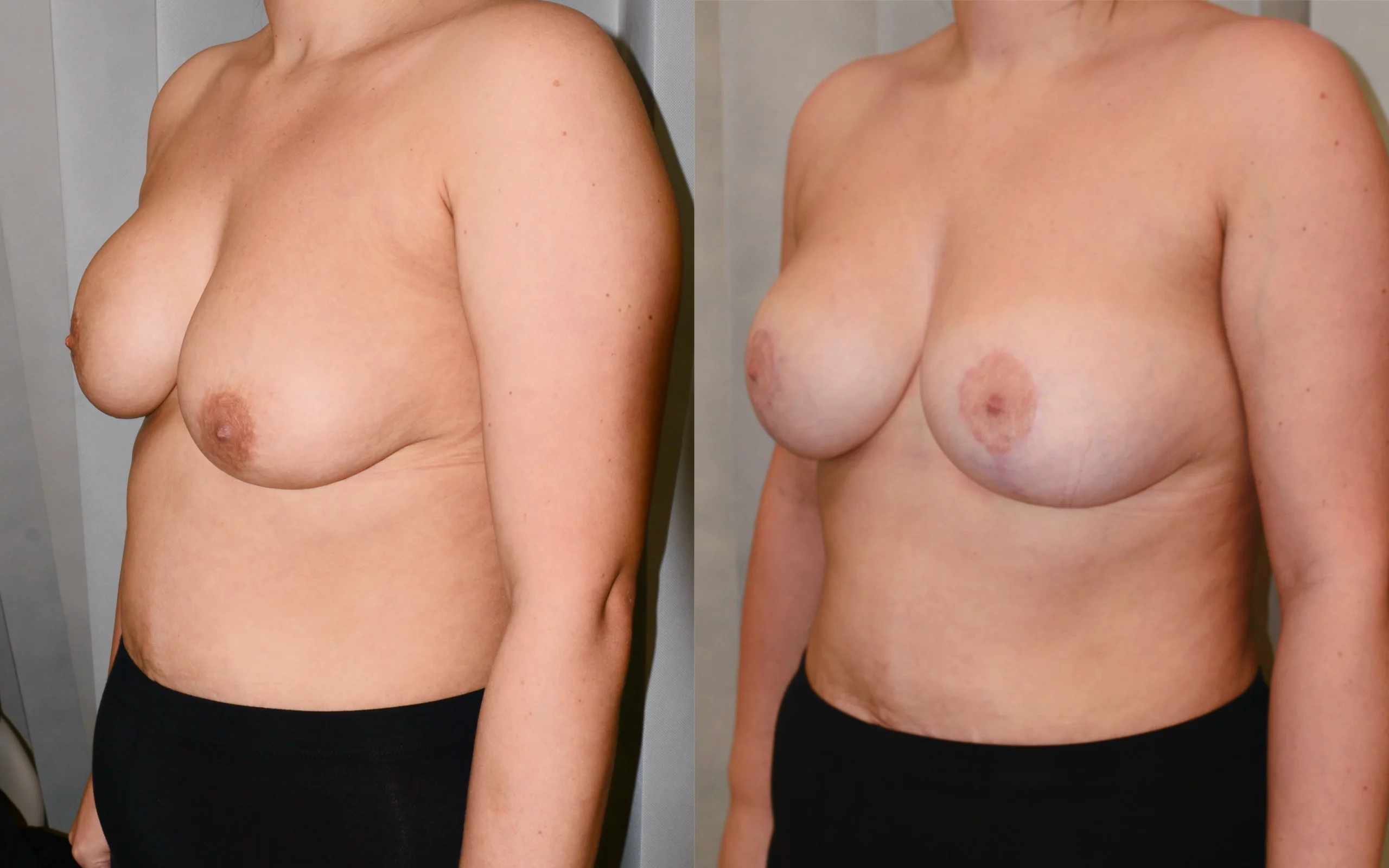 Correction of breast asymmetry