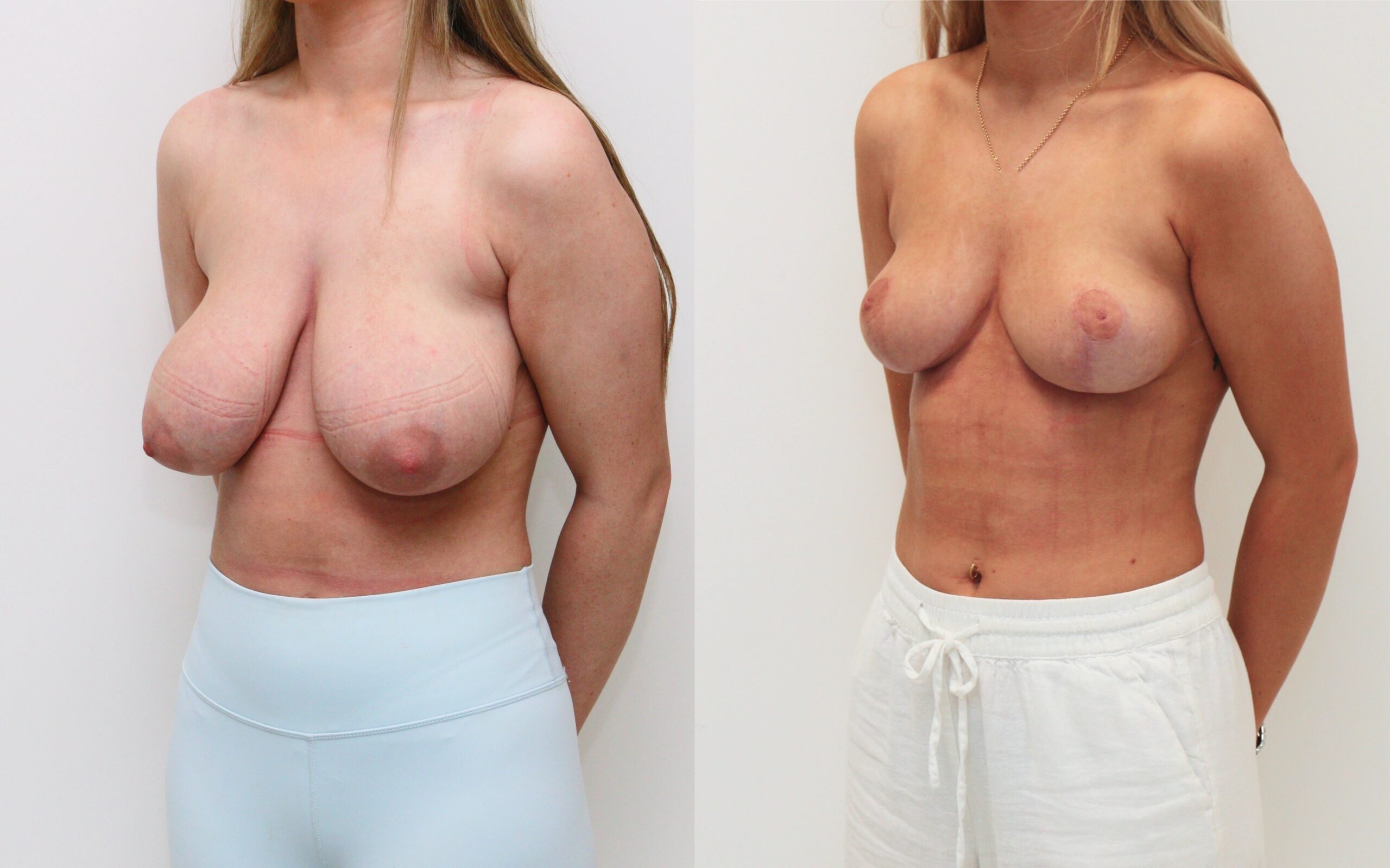 Breast uplift and small reduction