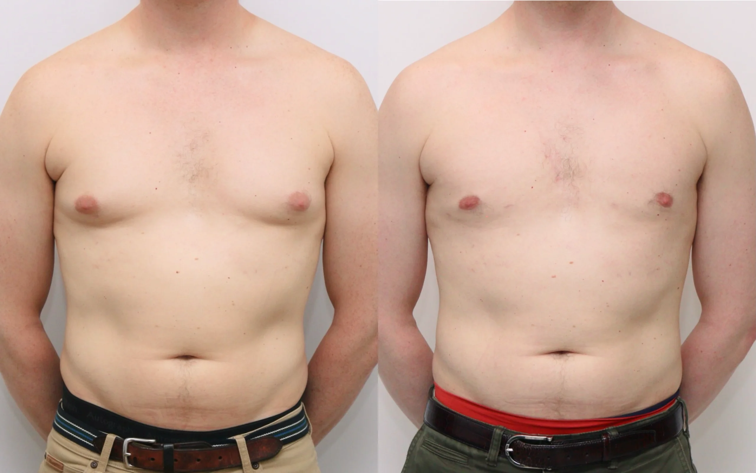 gynecomastia before and after