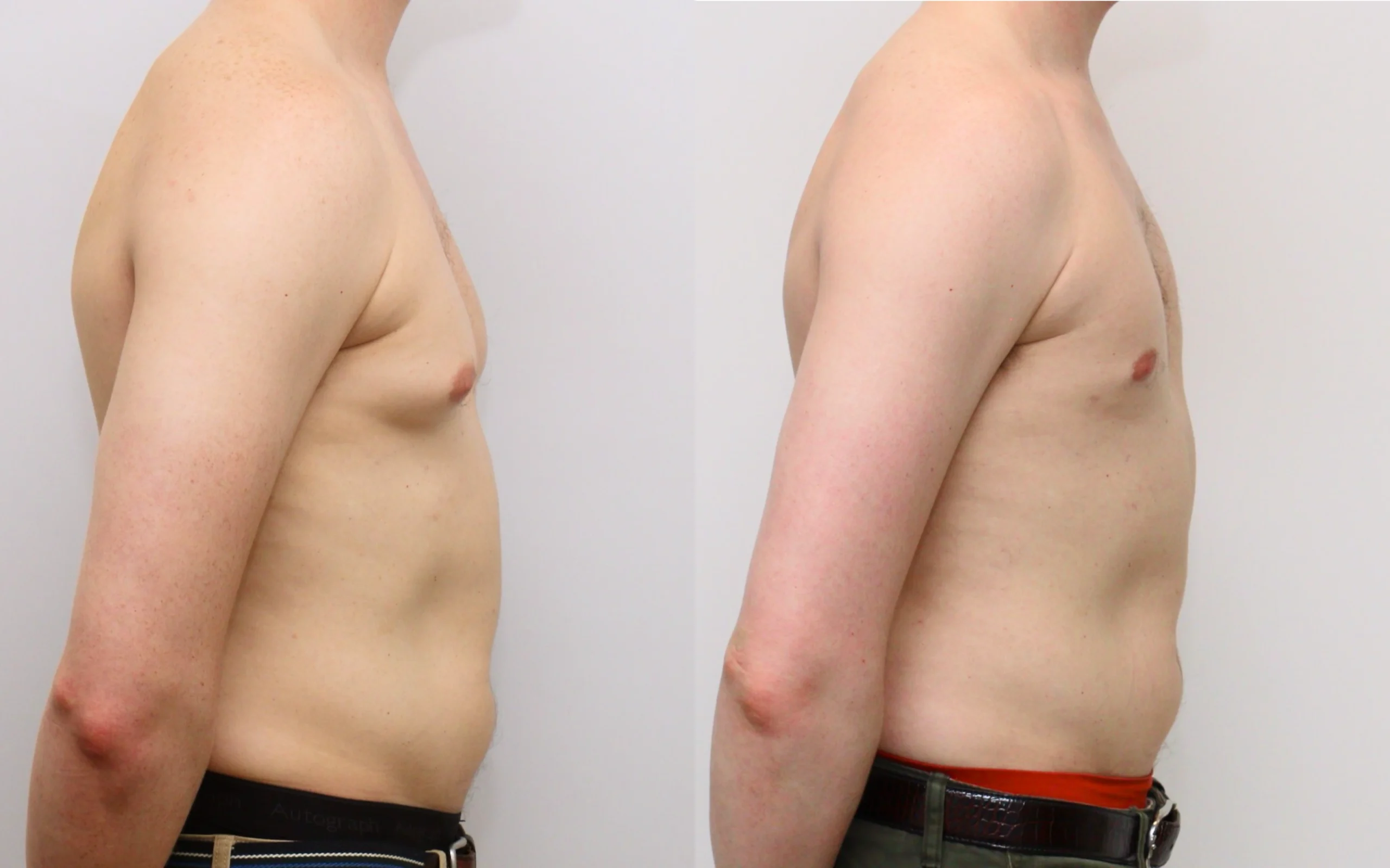 Gynecomastia liposuction result