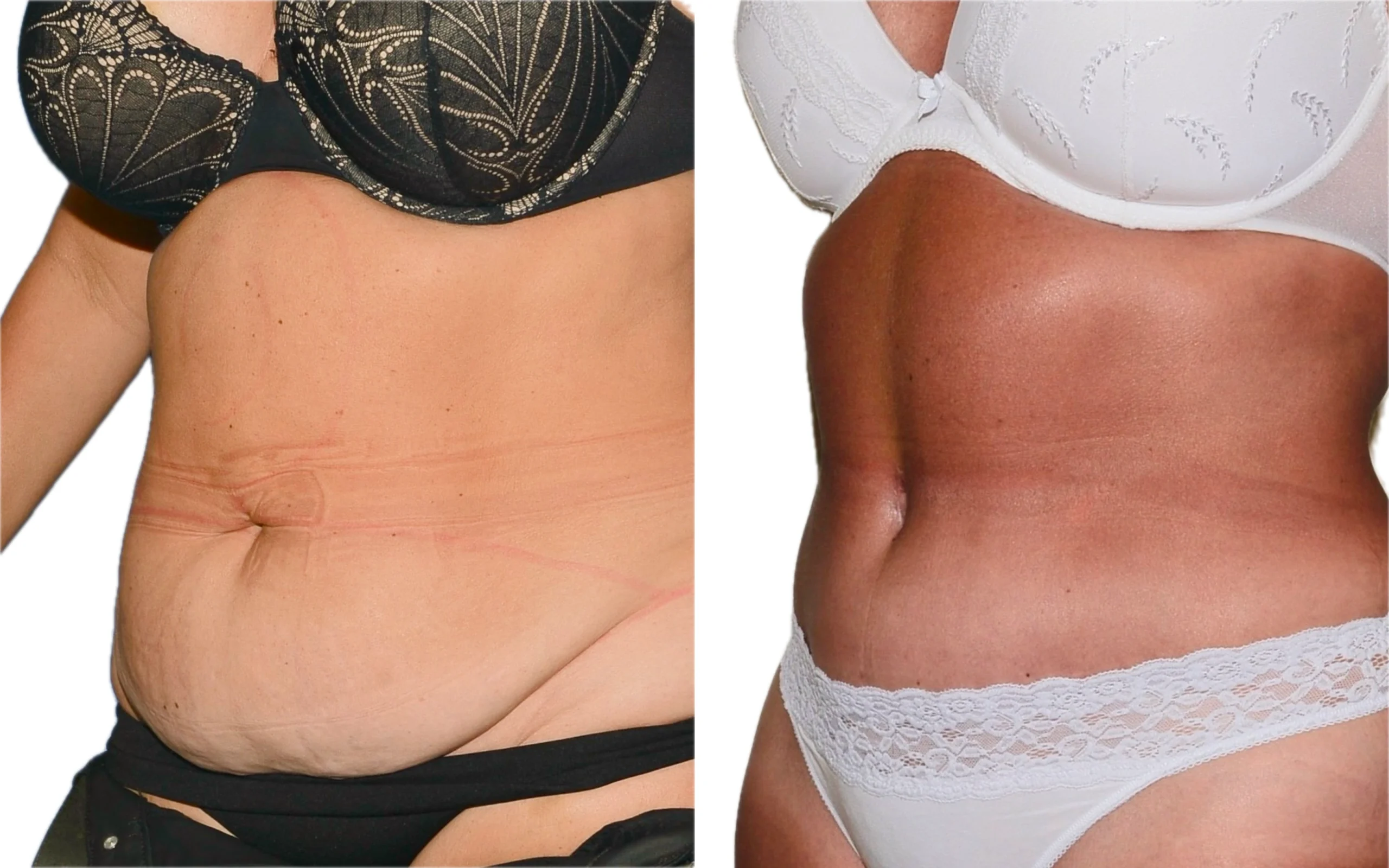 360 lipo and fully tummy tuck